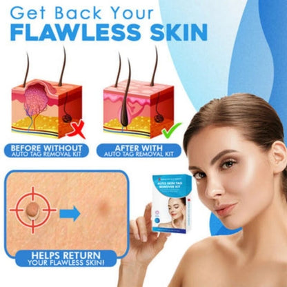 AU Natural Painless Skin Tag Mole Wart Removal Kit Auto SKIN TAG Bands Remover