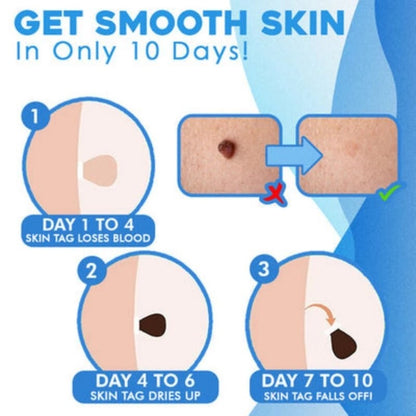 AU Natural Painless Skin Tag Mole Wart Removal Kit Auto SKIN TAG Bands Remover