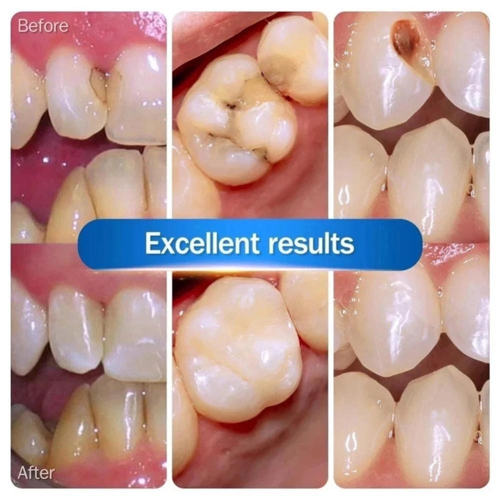 New Dental Cement Cavity Filling Strong Teeth Tooth Repair Restoration Filling