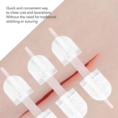 Zipper Tie Wound Closure Patch Hemostatic Patch Wound Fast Suture Zipper Band